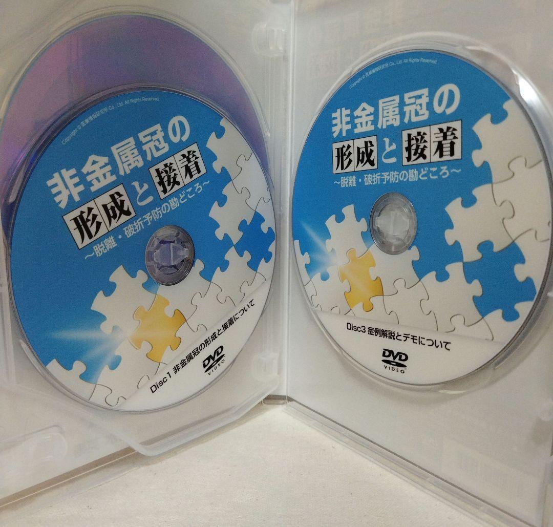 非金属冠の形成と接着　　　 　歯科衛生士　歯医者