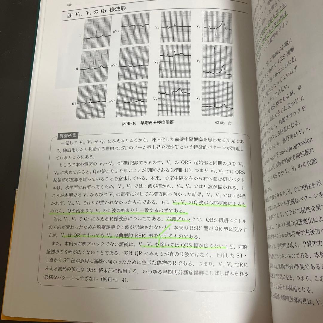 異常波形の読み方 心電図鑑別のチェックポイント